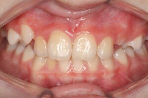 Cas client - Multibagues Ado - Avant - Face